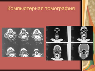Компьютерная томография 