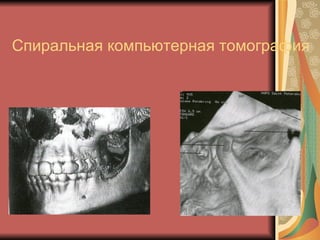 Спиральная компьютерная томография 