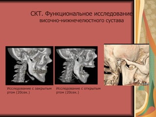 Исследование с открытым ртом (20сек.) Исследование с закрытым ртом (20сек.) СКТ. Функциональное исследование   височно-нижнечелюстного сустава 