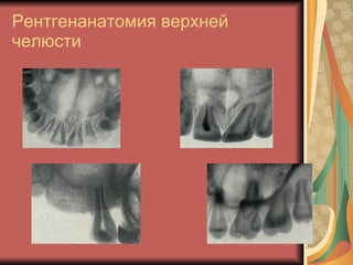 Рентгенанатомия верхней челюсти 