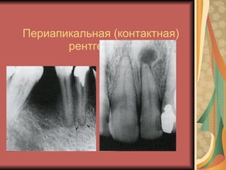 Периапикальная (контактная)  рентгенография. 