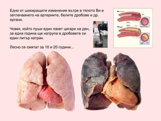 Едно от шокиращите изменения вътре в тялото Ви е затлачването на артериите, белите дробове и др. органи. Човек, който пуши един пакет цигари на ден, за една година ще натрупа в дробовете си един литър катран. Лесно се смятат за 10 и 20 години... 