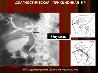 ЧЧХ с дренированием общего желчного протока Опухоль Опухоль ДИАГНОСТИЧЕСКАЯ  ПУНКЦИОННАЯ  ИР 