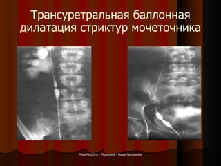 Трансуретральная баллонная дилатация стриктур мочеточника MeduMed.Org -  Медицина - Наше Призвание 