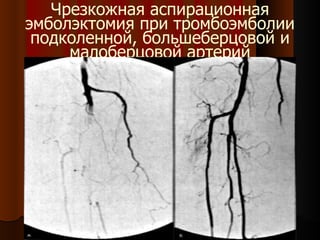 Чрезкожная аспирационная эмболэктомия при тромбоэмболии подколенной, большеберцовой и малоберцовой артерий 