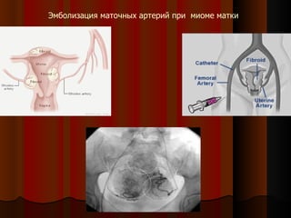Эмболизация маточных артерий при  миоме матки   