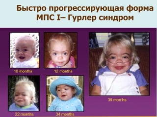 Быстро прогрессирующая форма МПС  І – Гурлер синдром 