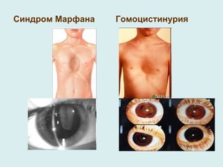 Синдром Марфана Гомоцистинурия 