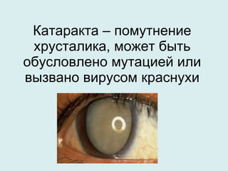 Катаракта – помутнение хрусталика, может быть обусловлено мутацией или вызвано вирусом краснухи 
