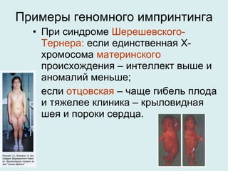 Примеры геномного импринтинга При синдроме  Шерешевского-Тернера:  если единственная Х-хромосома  материнского  происхождения – интеллект выше и аномалий меньше;  если  отцовская  – чаще гибель плода и тяжелее клиника – крыловидная шея и пороки сердца. 