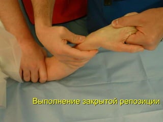 Выполнение закрытой репозиции 