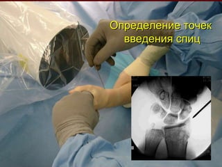 Определение точек введения спиц 