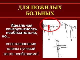 ДЛЯ ПОЖИЛЫХ БОЛЬНЫХ Идеальная конгруэнтность необязательна, но...   восстановление длины лучевой кости необходимо ! 