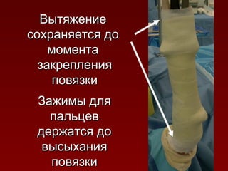 Вытяжение сохраняется до момента закрепления повязки Зажимы для пальцев держатся до высыхания повязки 