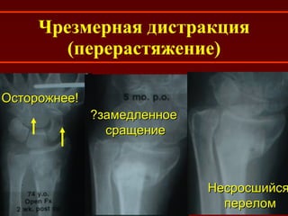 Чрезмерная дистракция (перерастяжение) ?замедленное  сращение Несросшийся перелом Осторожнее! 