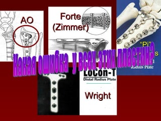 Какая ошибка  у всех этих пластин? AO Forte (Zimmer) Wright “ Pi” Synthes 