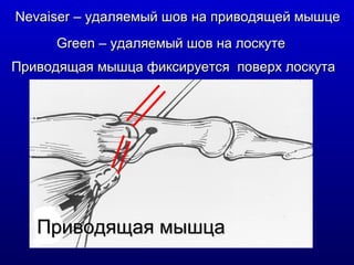 Приводящая мышца Nevaiser –  удаляемый шов на приводящей мышце Green –  удаляемый шов на лоскуте Приводящая мышца фиксируется  поверх лоскута 