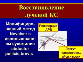 Восстановление лучевой КС Модифициро-ванный метод  Nevaiser  с использовани-ем сухожилия  abductor pollicis brevis   Лоскут, прикрепляющийся к кости Реинсерция APB 