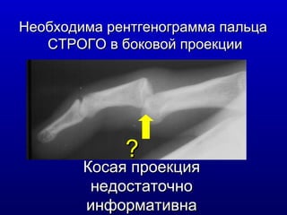 Необходима рентгенограмма пальца  СТРОГО в боковой проекции Косая проекция недостаточно информативна ? 