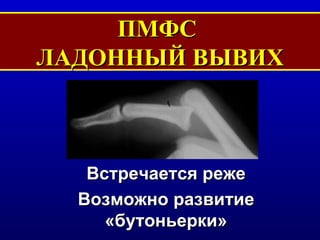 ПМФС  ЛАДОННЫЙ ВЫВИХ Встречается реже Возможно развитие «бутоньерки» 