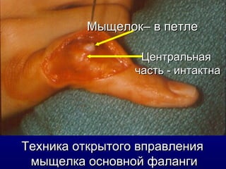 Техника открытого вправления  мыщелка основной фаланги Мыщелок– в петле Центральная  часть - интактна 