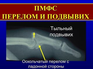 ПМФС  ПЕРЕЛОМ И ПОДВЫВИХ  Оскольчатый перелом с  ладонной стороны Тыльный подвывих 