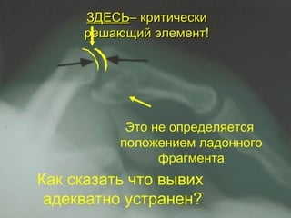 Как сказать что вывих  адекватно устранен ? Это не определяется положением ладонного фрагмента ЗДЕСЬ – критически решающий элемент ! 