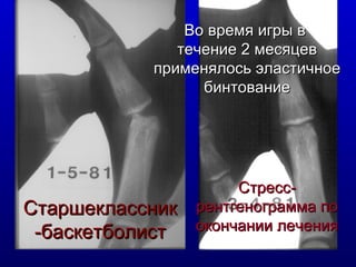Старшеклассник -баскетболист Во время игры в  течение 2 месяцев применялось эластичное  бинтование Стресс-рентгенограмма по окончании лечения 