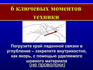 6  ключевых моментов техники Погрузите край ладонной связки в углубление  –  закрепите внутрикостно, как якорь, с помощью удаляемого шовного материала ( не проволоки ) 