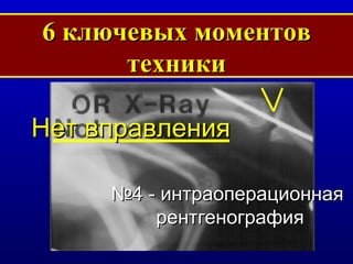 6  ключевых моментов техники № 4  -   интраоперационная  рентгенография Нет вправления 