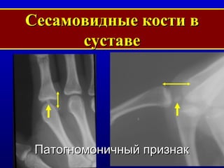 Сесамовидные кости в суставе Патогномоничный признак  