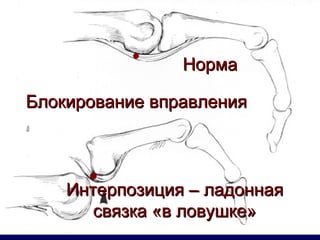 Блокирование вправления Норма Интерпозиция – ладонная связка «в ловушке» 