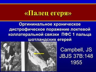 «Палец егеря» Оргининальное хроническое дистрофическое поражение локтевой коллатеральной   связки  ПФС 1 пальца шотландских егерей Campbell, JS JBJS 37B:148 1955 