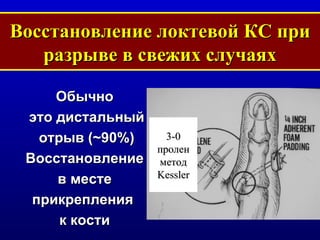 Восстановление локтевой КС при разрыве в свежих случаях Обычно это дистальный отрыв  ( ~ 90%) Восстановление в месте  прикрепления  к кости 3-0 пролен метод  Kessler 
