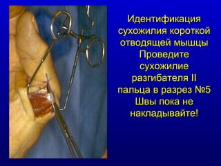 Идентификация сухожилия короткой отводящей мышцы Проведите сухожилие разгибателя  II  пальца в разрез № 5 Швы пока не накладывайте ! 