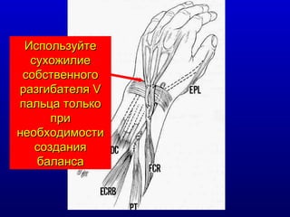 Используйте сухожилие собственного разгибателя  V  пальца только при необходимости создания баланса 
