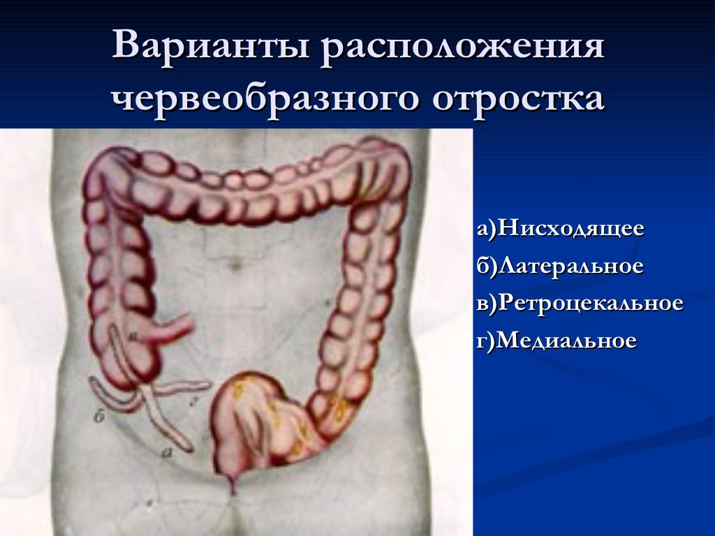 Острый аппендицит