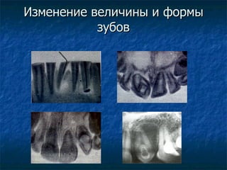 Изменение величины и формы зубов 