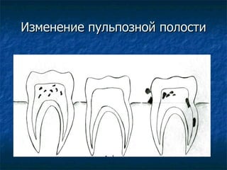 Изменение пульпозной полости 