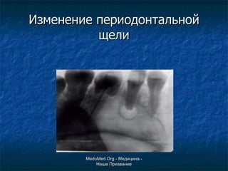 Изменение периодонтальной щели MeduMed.Org -  Медицина - Наше Призвание 