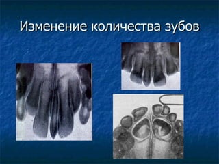 Изменение количества зубов 