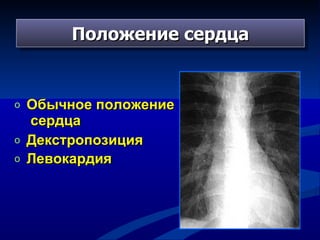 Положение сердца Обычное положение  сердца Декстропозиция Левокардия   