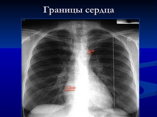 Границы сердца 2-3см 1см 