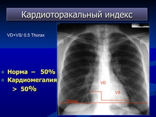 Кардиоторакальный индекс Норма  –  50% Кардиомегалия  –  >  5 0 % VD VS Thorax VD+VS /  0.5 Thorax 