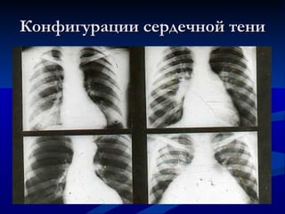 Конфигурации сердечной тени 