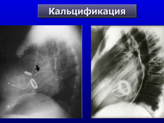Кальцификация Лев.перед.нисход Опоясывающ арт. 