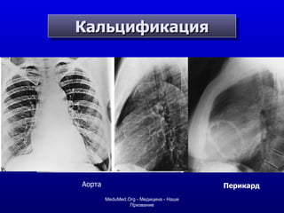 Кальцификация Аорта Перикард MeduMed.Org -  Медицина - Наше Призвание 