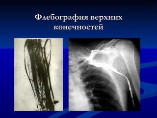 Флебография верхних конечностей 