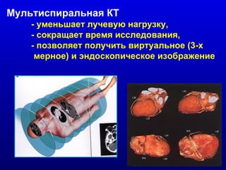 Мультиспиральная КТ   - уменьшает лучевую нагрузку, - сокращает время исследования,  - позволяет получить виртуальное (3-х мерное) и эндоскопическое изображение 