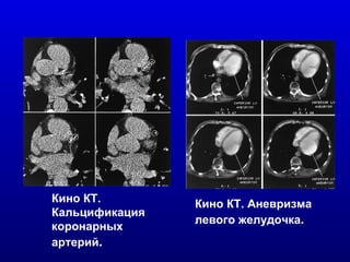 Кино КТ. Аневризма левого желудочка . Кино КТ. Кальцификация коронарных артерий . 